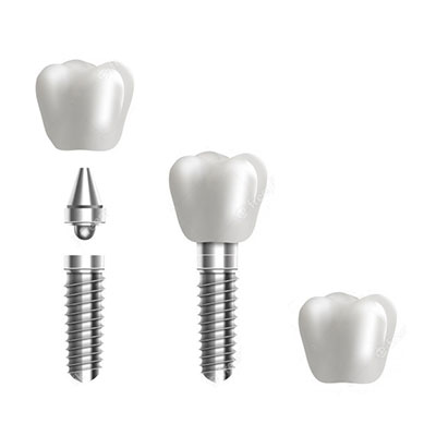 Peças em Titânio para Implantes Odontológicos